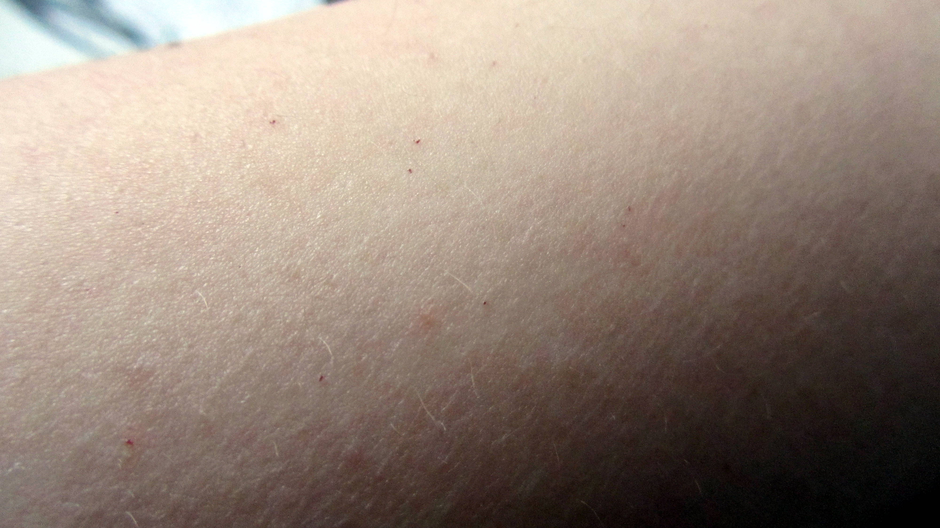 Rote Punktchen Auf Den Armen Blut Arm Rotung