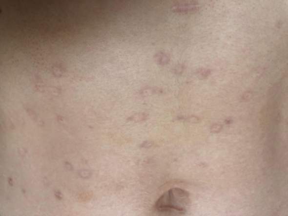 - (Haut, Dermatologie, Flecken)