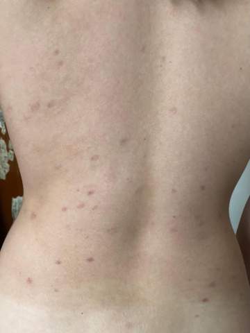 - (Haut, Dermatologie, Flecken)