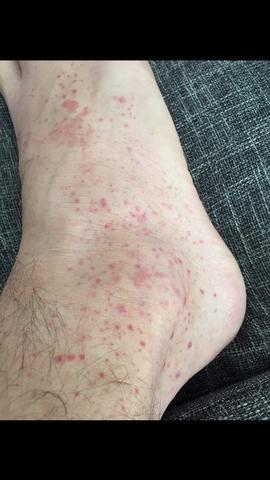 Rote Punkte An Den Beinen Was Ist Das Beine Ausschlag Flecken Rote Punkte An Den Beinen Was Ist Das Beine Ausschlag Flecken
