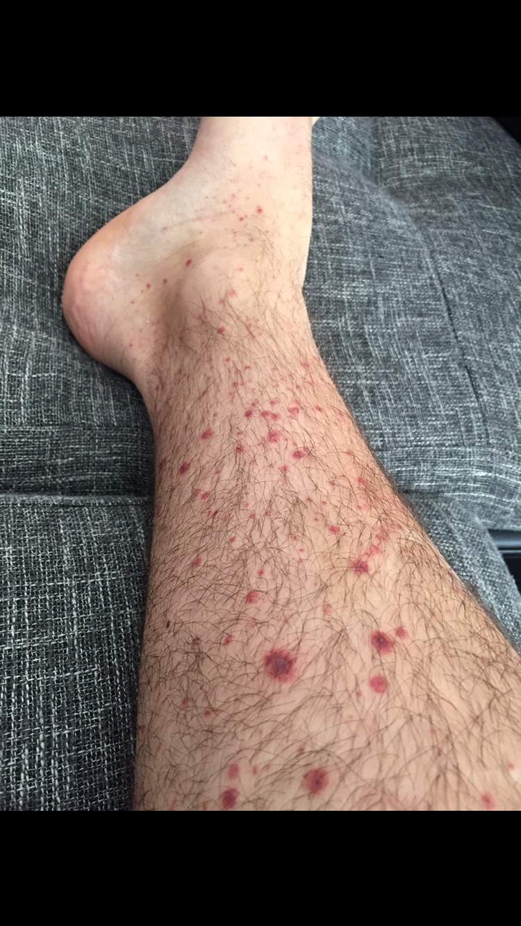 Rote Punkte an den Beinen?? Was ist das? (Ausschlag, Beine, Flecken) Rote Punkte an den Beinen?? Was ist das? (Ausschlag, Beine, Flecken)