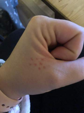 Rote Punkte auf der Hand?