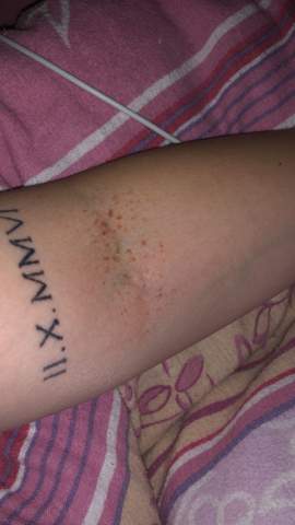 Rote Punkte In Der Armbeuge Haut Ausschlag Rote Punkte In Der Armbeuge Haut Ausschlag