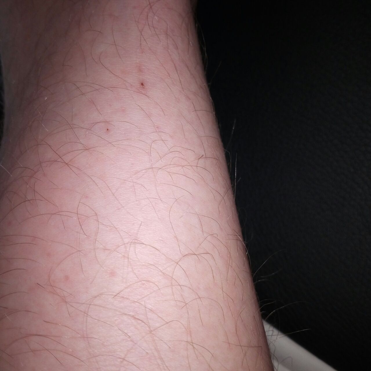 Rote Punkte Schienbein Fuß? (Haut, Arzt, Dermatologie)