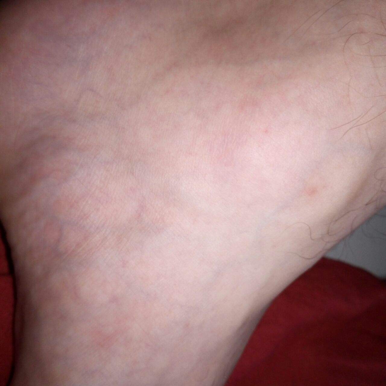 Rote Punkte Schienbein Fuß? (Haut, Arzt, Dermatologie) Rote Punkte Schienbein Fuß? (Haut, Arzt, Dermatologie)