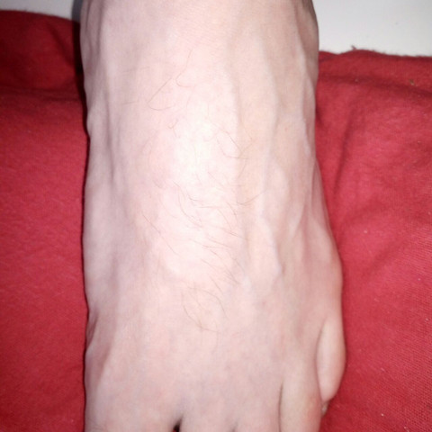 Fußrücken - (Haut, Arzt, Dermatologie)