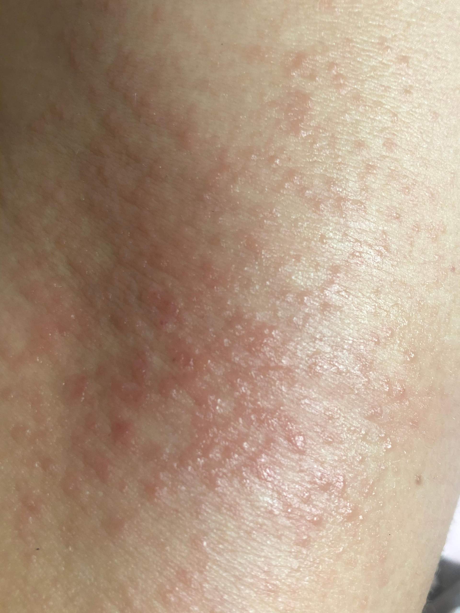 Rote Pusteln an den Beinen? (Haut, Pickel, Ausschlag)