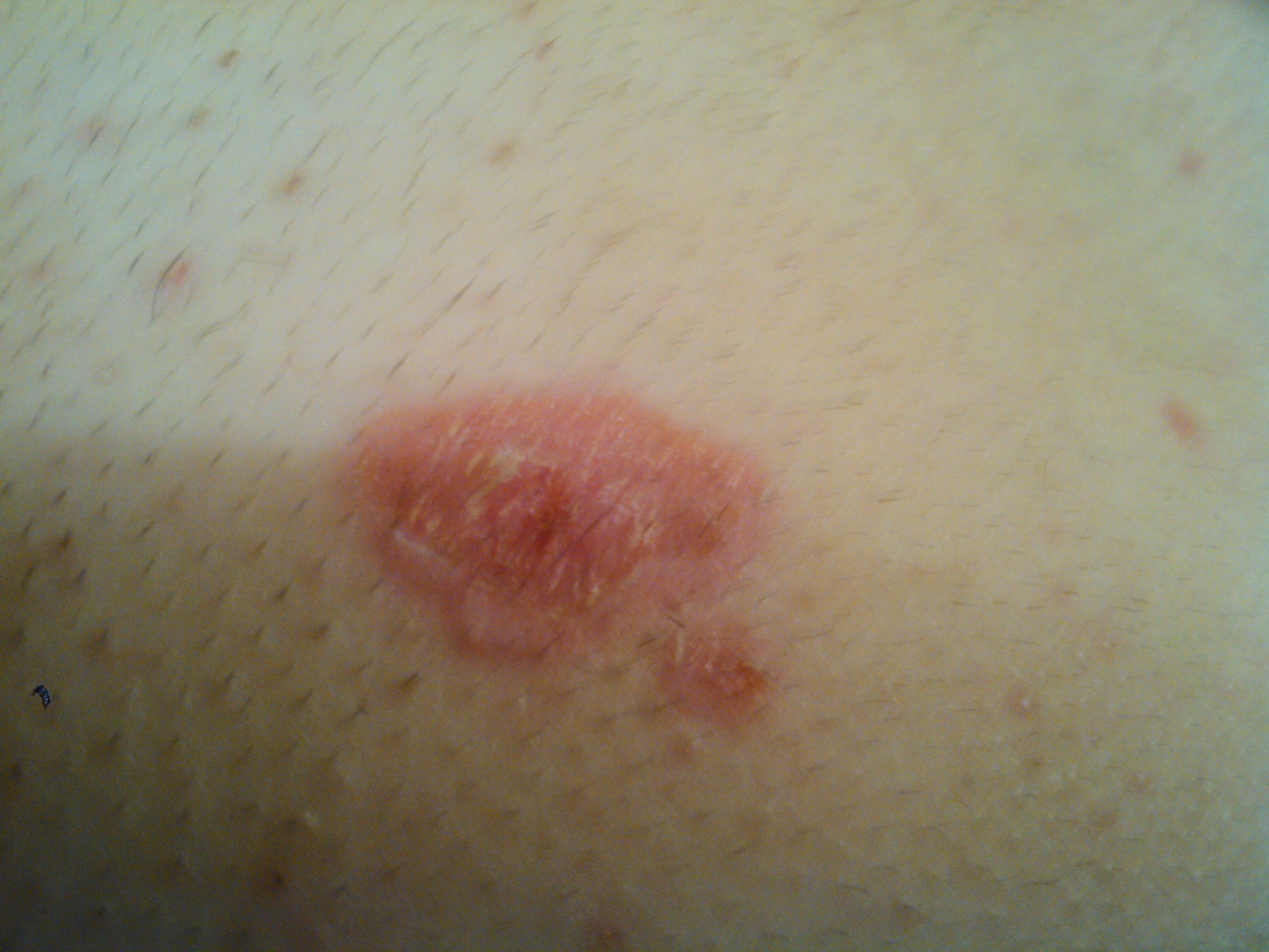 Rote, runde,nässende Flecken auf der Haut (Medizin, Ursache, Krankheit) Rote, runde,nässende Flecken auf der Haut (Medizin, Ursache, Krankheit)