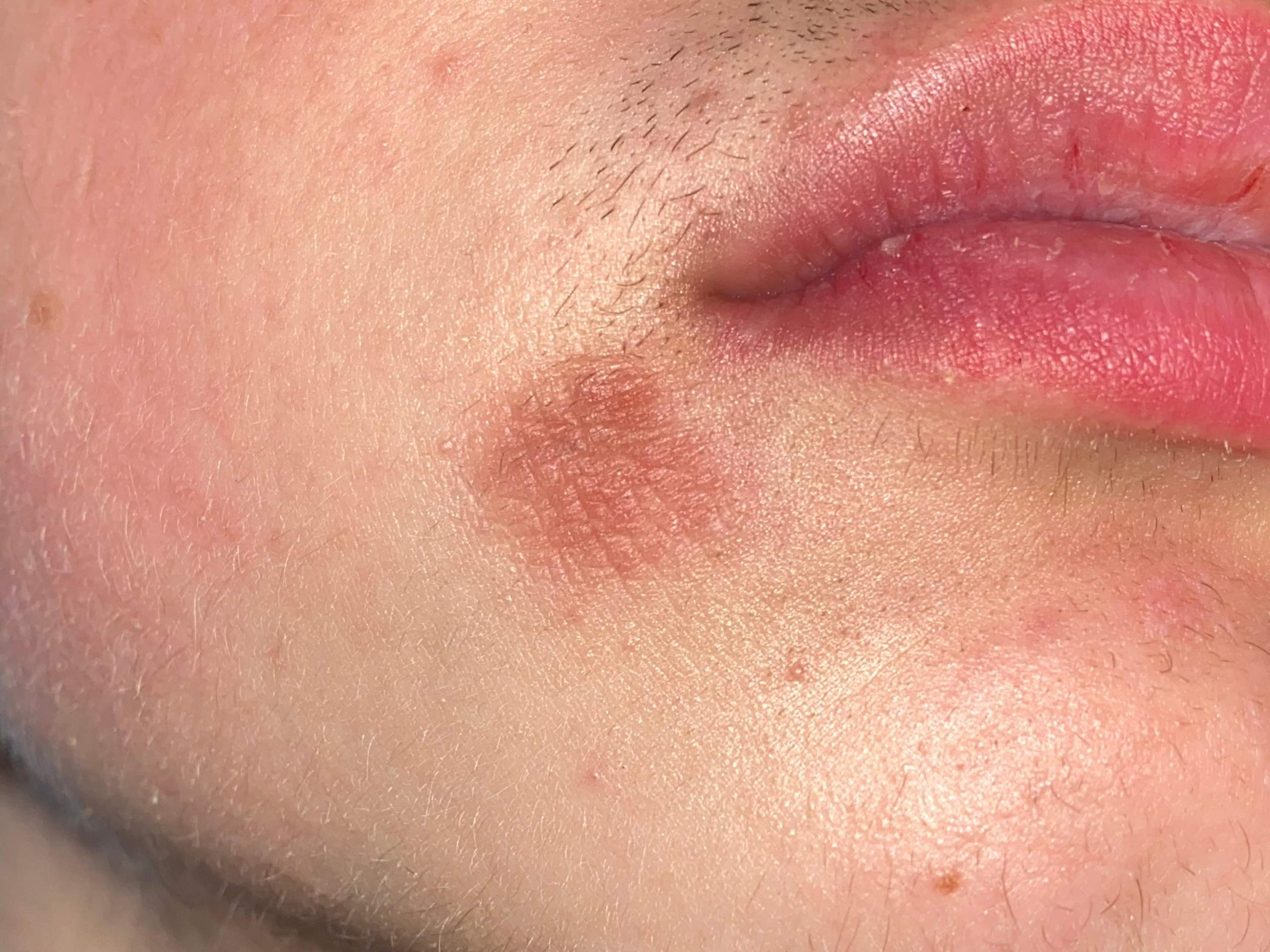 Rote Stelle an Lippe/Mund? (Entzündung, Ausschlag, Herpes)