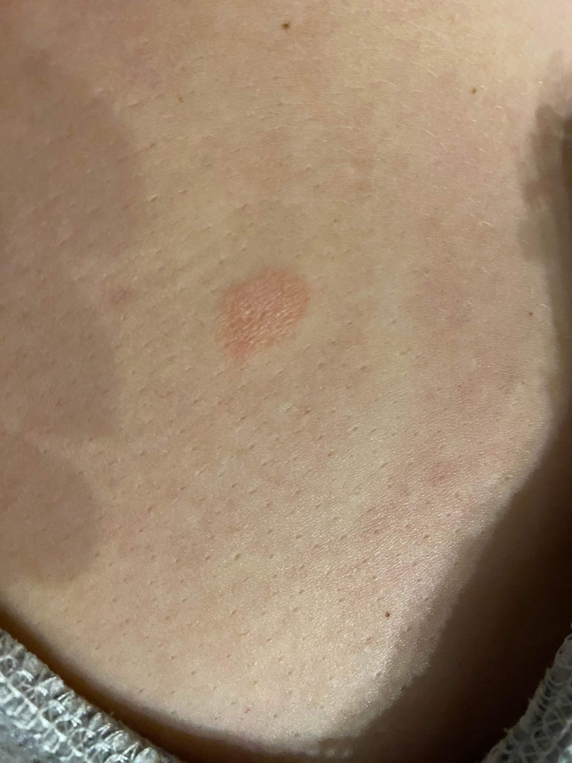 Rote Stelle Brust? (Haut, Rötung)