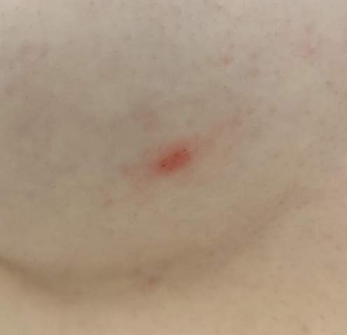 Roter juckender Fleck auf der Haut. Was kann das sein?