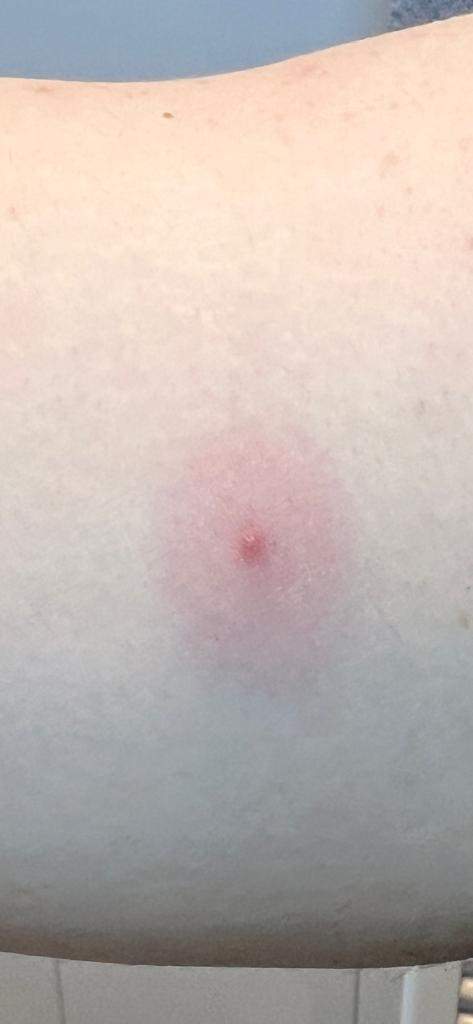 Roter Kreis um "Pickel"? (Arztbesuch, Blutvergiftung)