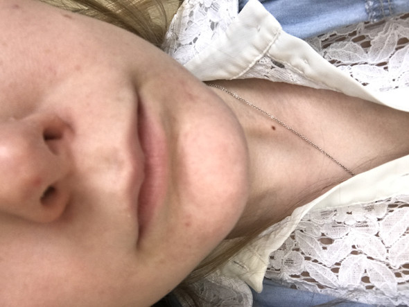 - (Haut, Nase, Dermatologie)