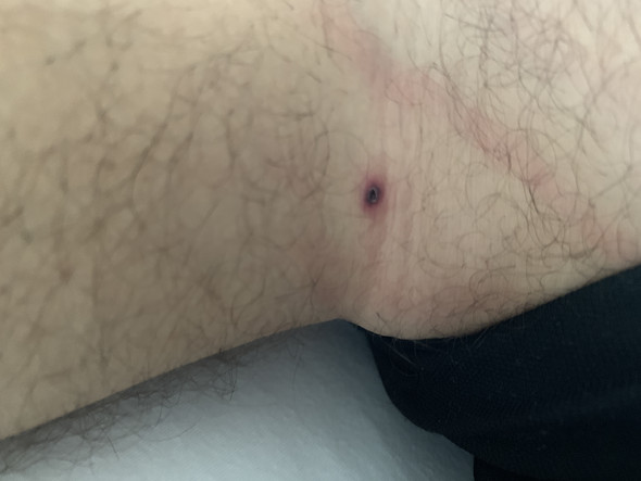 Roter Punkt auf Haut. Was ist das?