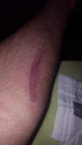 Blutvergiftung Arm Blutvergiftung Arm