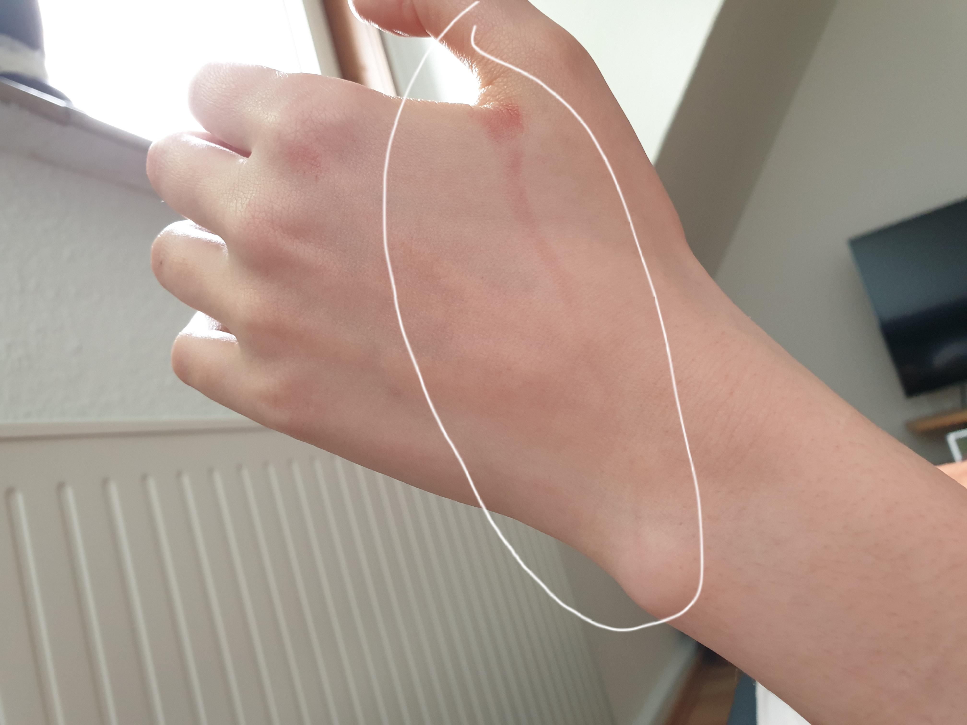 Wie Sieht Der Rote Strich Bei Einer Blutvergiftung Aus Roter Strich nach Verbrennung? (Blutvergiftung)