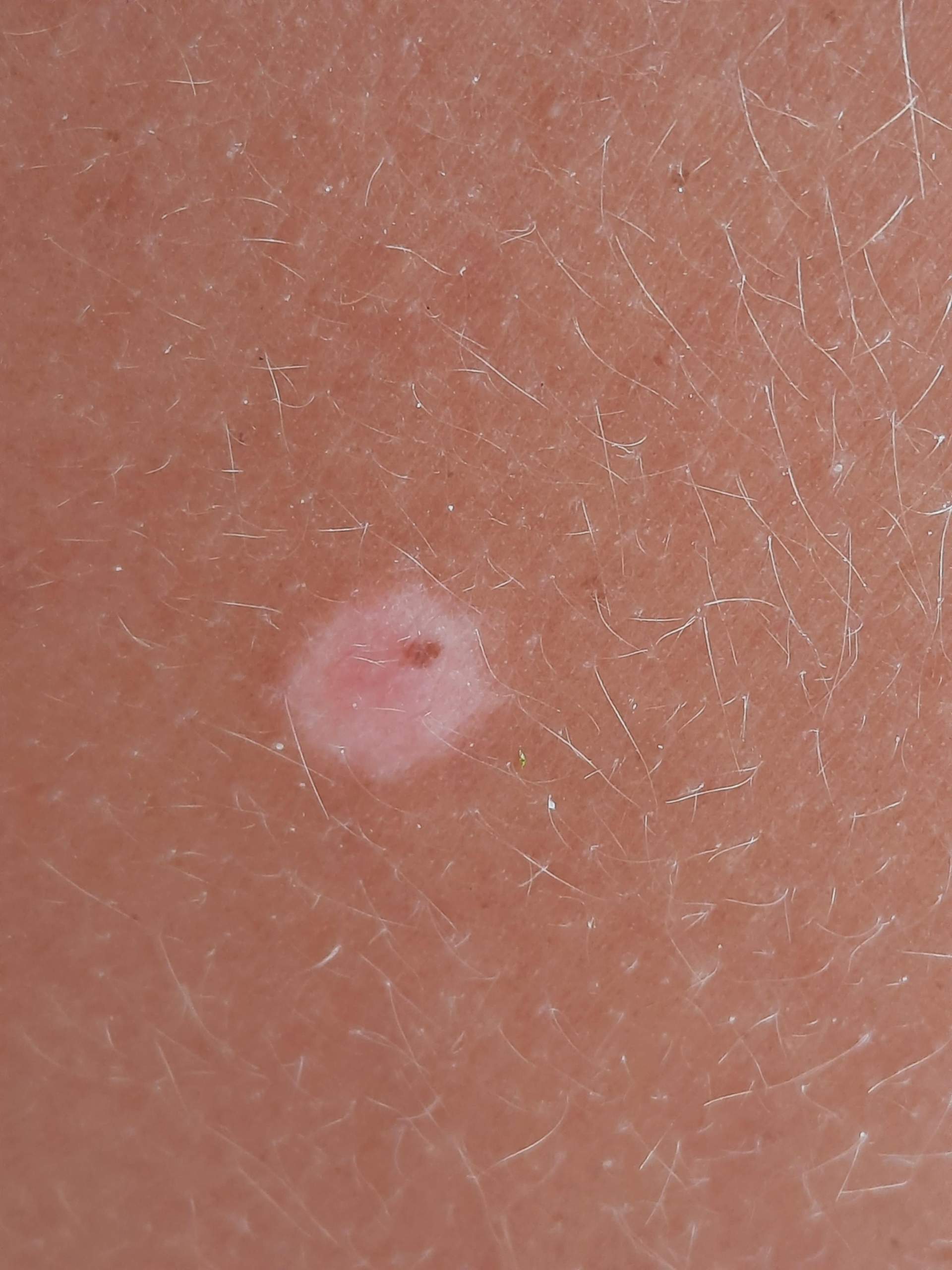 Runde Flecken auf der Haut. Eher rosa auf brauner Haut? (Sonnenbrand)