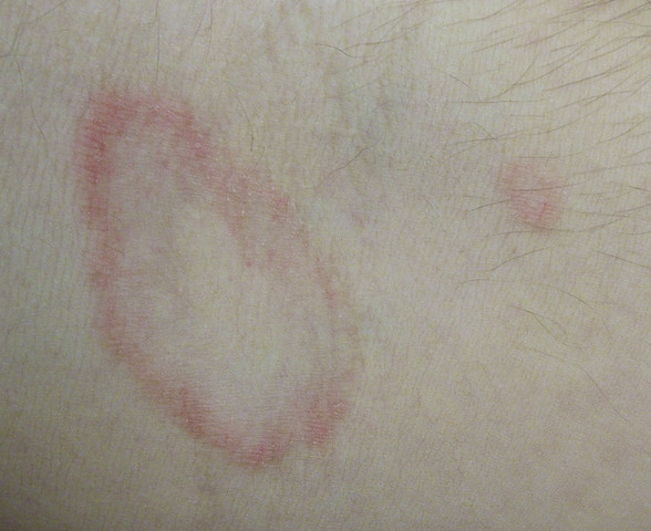 Runde Rötung in Armbeuge? (Haut, Ausschlag)