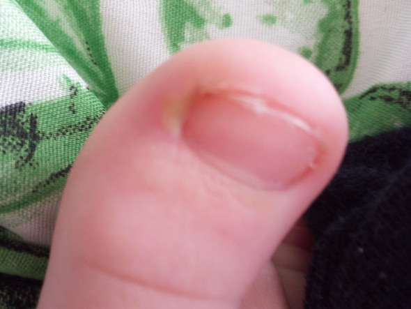 Salben Oder Besse Zum Arzt Salbe Nagelbettentzundung Eingewachsener Nagel Salben Oder Besse Zum Arzt Salbe Nagelbettentzundung Eingewachsener Nagel