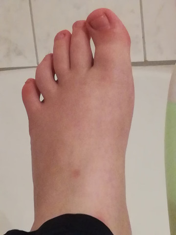 Schiefer Zeh zum Orthopäden? (Arzt)