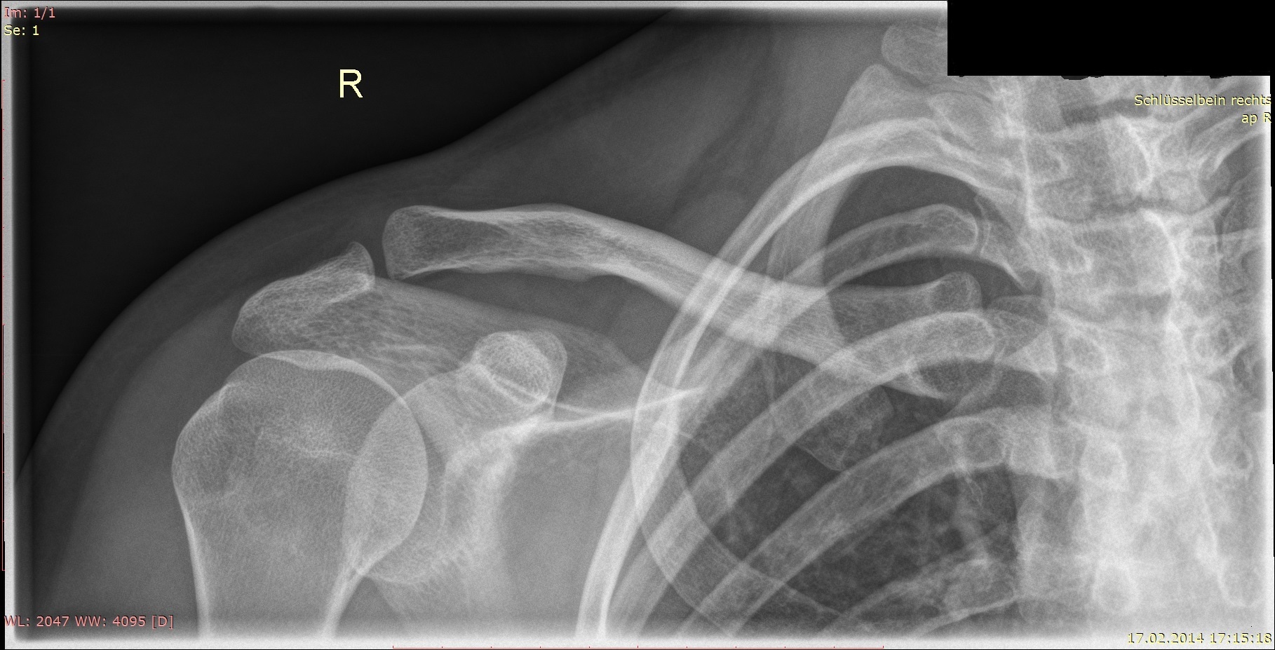 Schlüsselbein in Ordnung? (Schmerzen, Chirurgie, Radiologie) Schlüsselbein in Ordnung? (Schmerzen, Chirurgie, Radiologie)