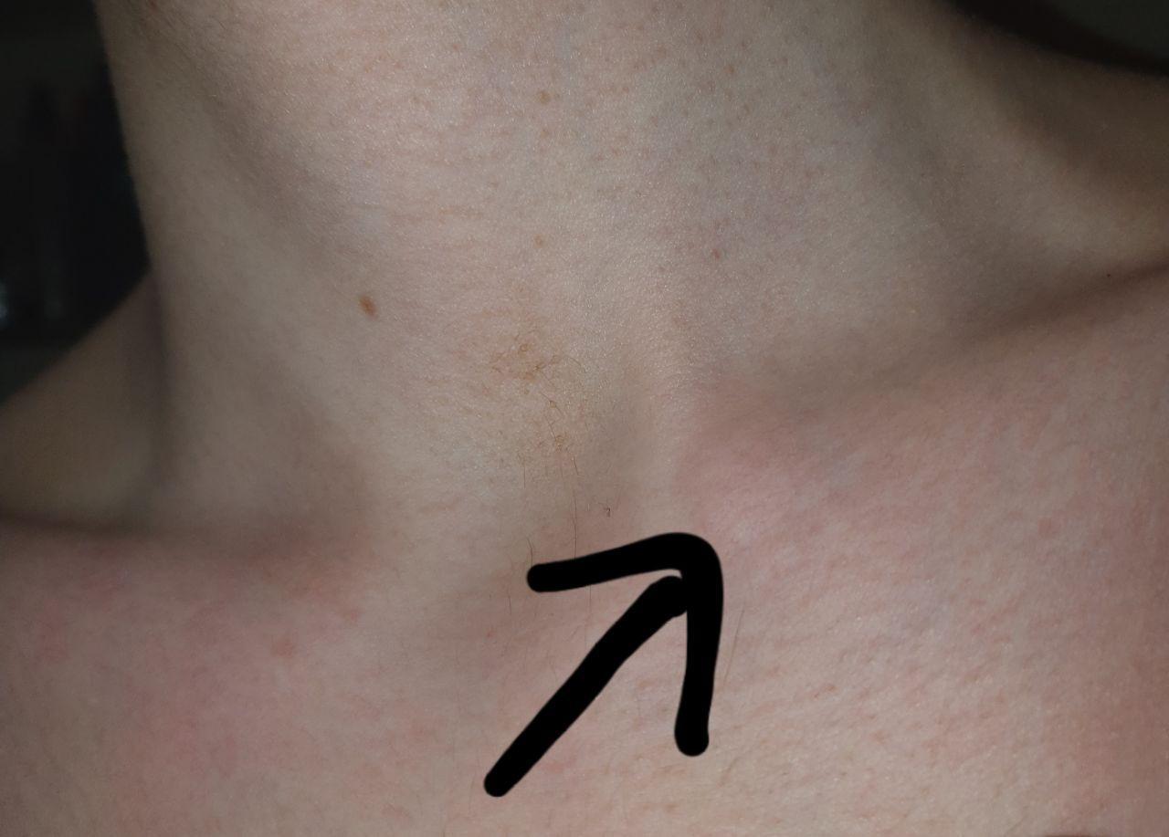 Schlüsselbeinknochen assymmetrisch und Knochen größer?