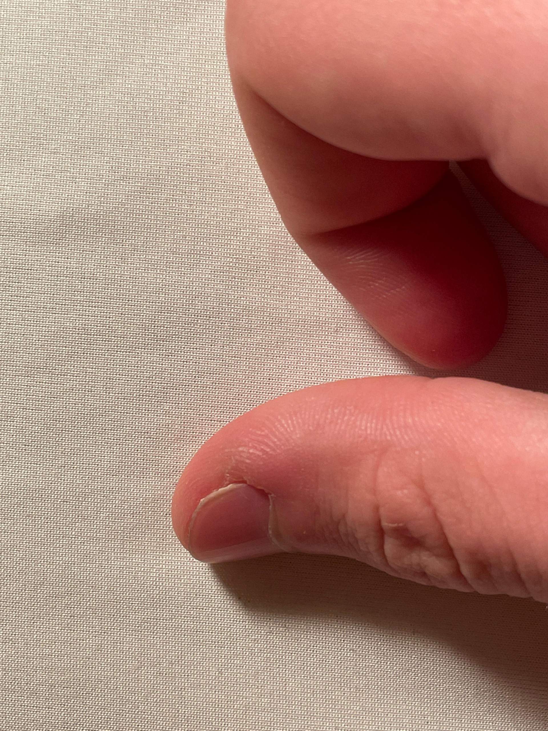 Schmerzen neben Daumennagel? (Fingernägel)