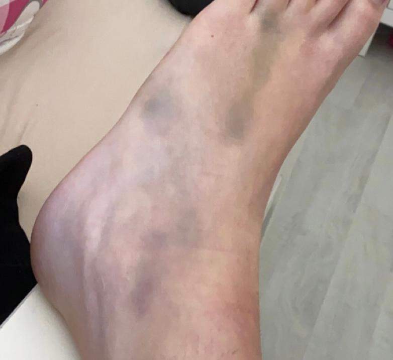 Schmerzen und Verfärbungen 5 Wochen nach Mittelfußbruch? (Arzt, Füße, Orthopädie)