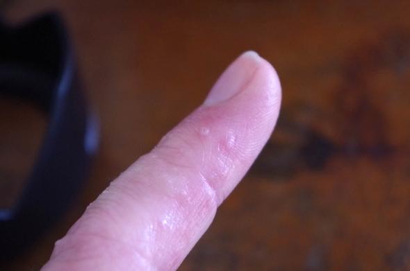 Kleiner Finger - (Hautausschlag, Blasen)