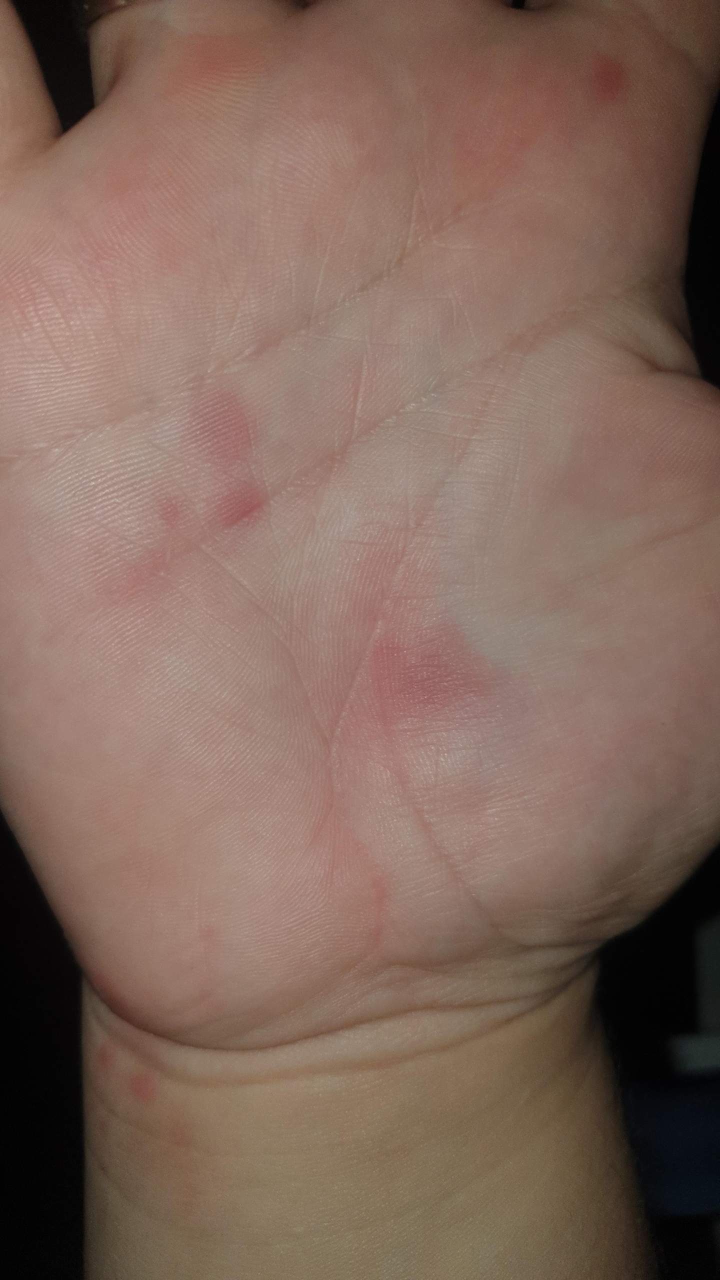 Schmerzende rote flecken Handinnenflächen? (Haut) Schmerzende rote flecken Handinnenflächen? (Haut)