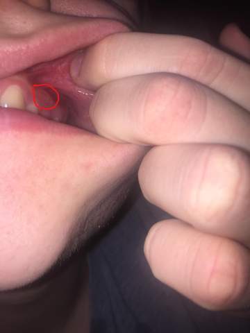 Schmerzende Stelle am Zahnfleisch?