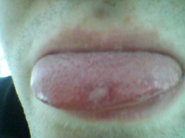 46+ Pickel Auf Der Zunge Background