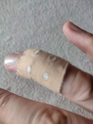 Schnittverletzung Finger noch leicht krumm verheilt das?