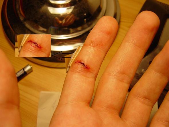 Schnittwunde Keine Blutung Mehr Keine Gute Wundrandverbindung Arzt Wunde Arztbesuch Schnittwunde Keine Blutung Mehr Keine Gute Wundrandverbindung Arzt Wunde Arztbesuch