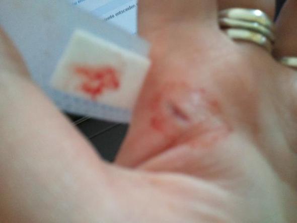 Schnittwunde Arzt Schnittwunde Arzt