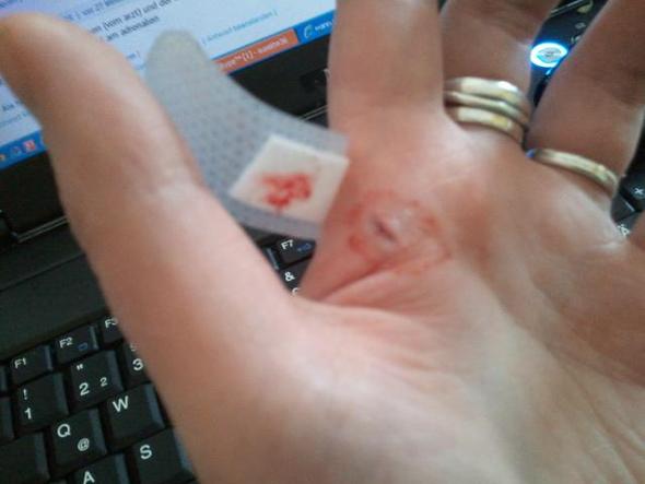 Schnittwunde Arzt Schnittwunde Arzt