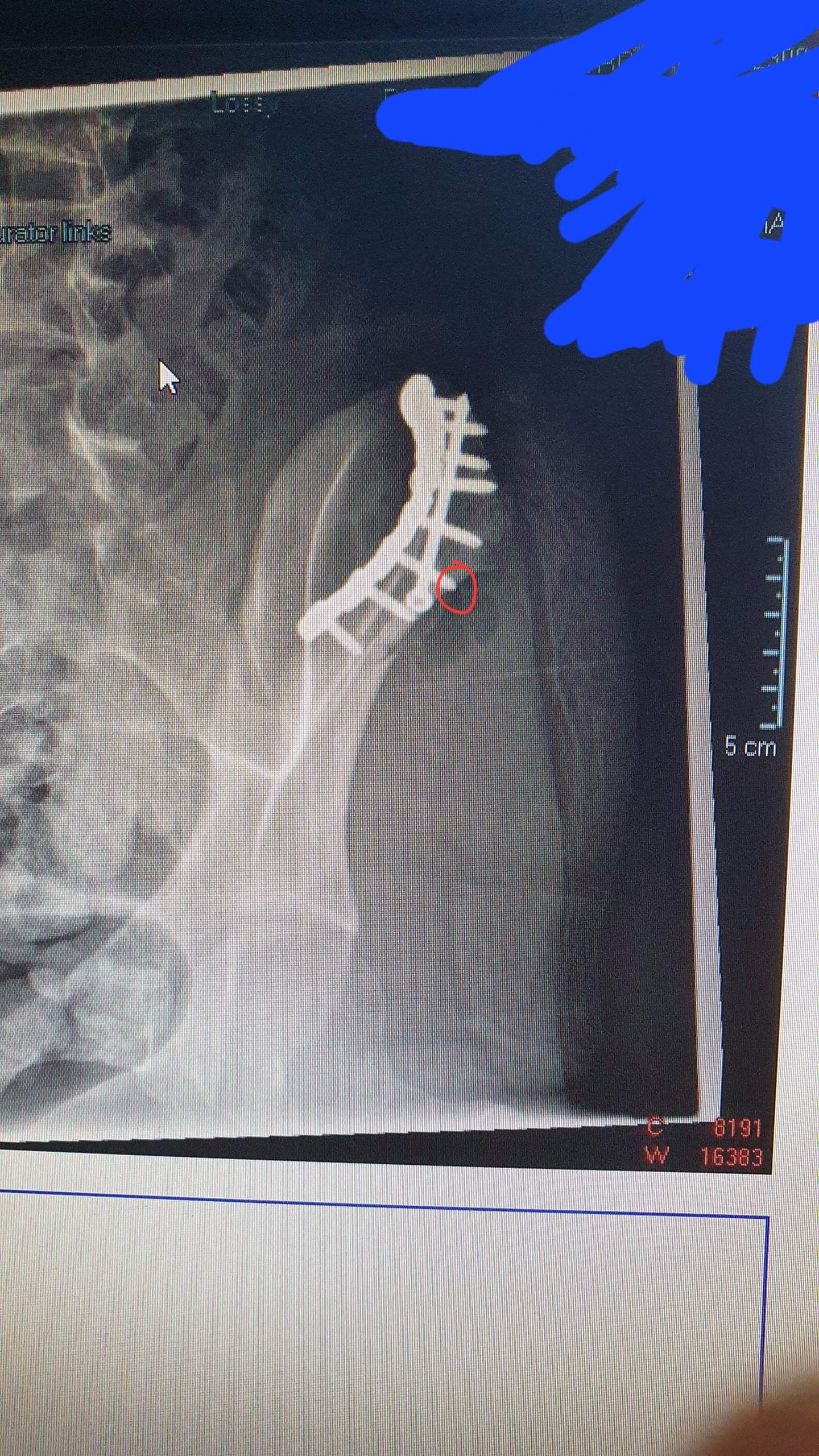 Schrauben und Platte entfernen lassen? (Schmerzen, Operation, Unfall)