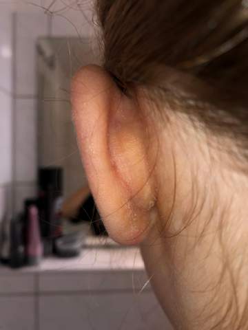 (Schuppig) raue Haut hinter dem linken Ohr?