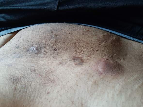 Intimbereich psoriasis Schuppenflechte im