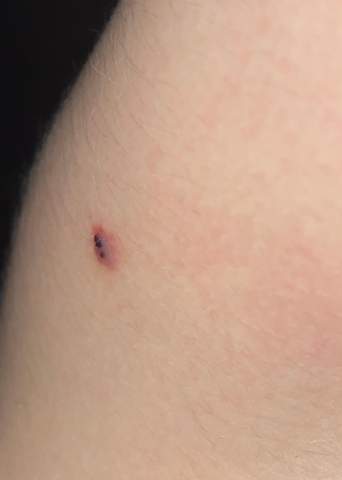 Schwarze Punkte Blaschen Auf Der Haut Was Ist Das Dermatologie Hautkrebs Hautkrankheit Schwarze Punkte Blaschen Auf Der Haut Was Ist Das Dermatologie Hautkrebs Hautkrankheit