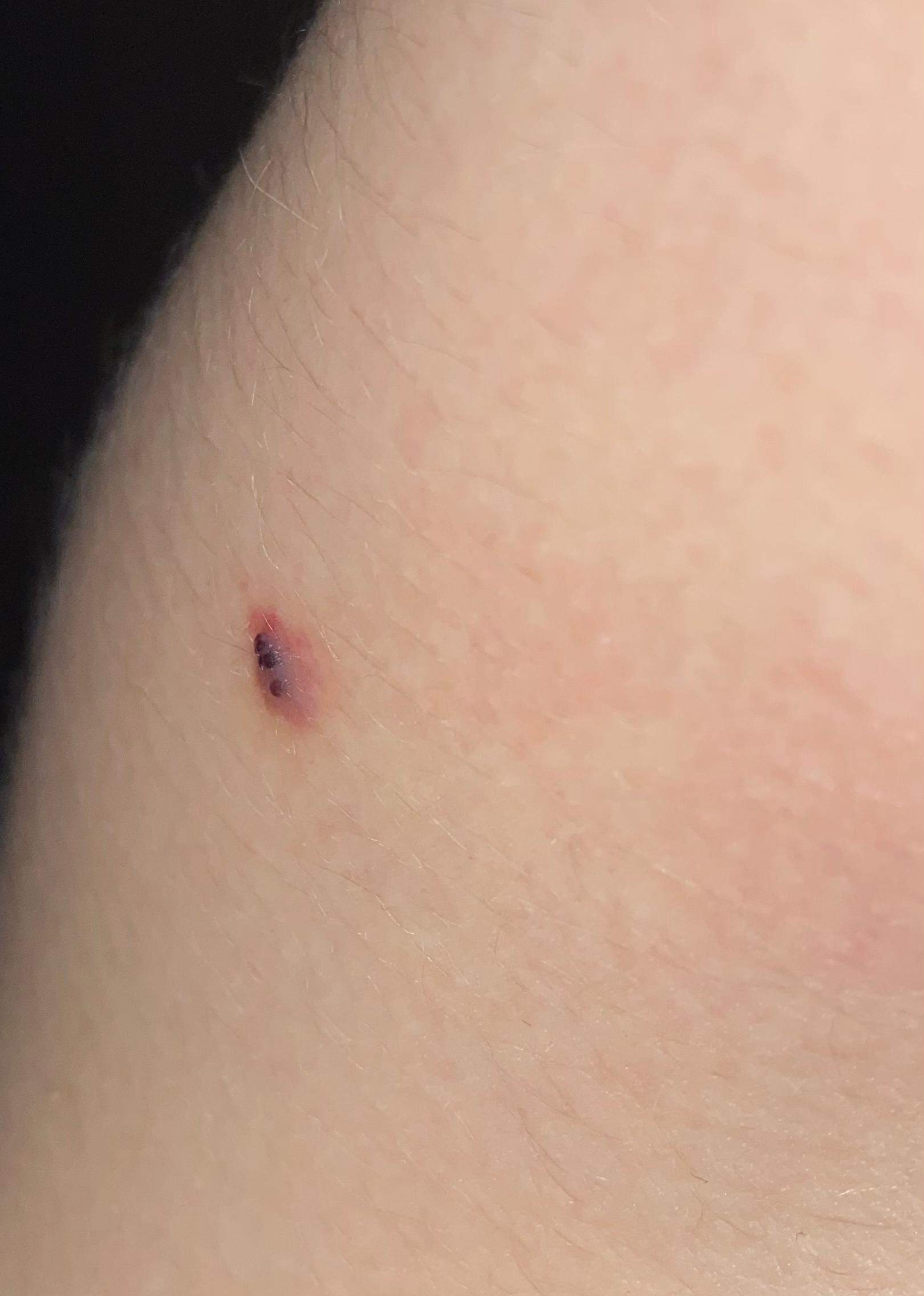 Schwarze Punkte/Bläschen auf der Haut, was ist das? (Dermatologie, Hautkrebs, Hautkrankheit)
