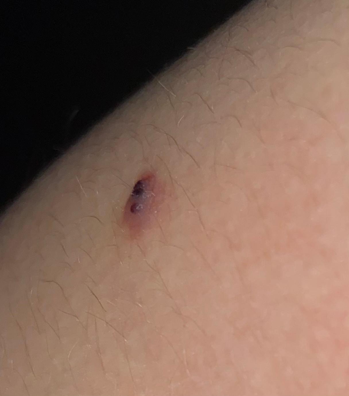 Schwarze Punkte/Bläschen auf der Haut, was ist das? (Dermatologie