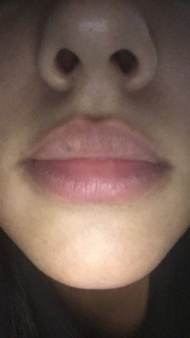 Bild - (Lippe, Flecken)