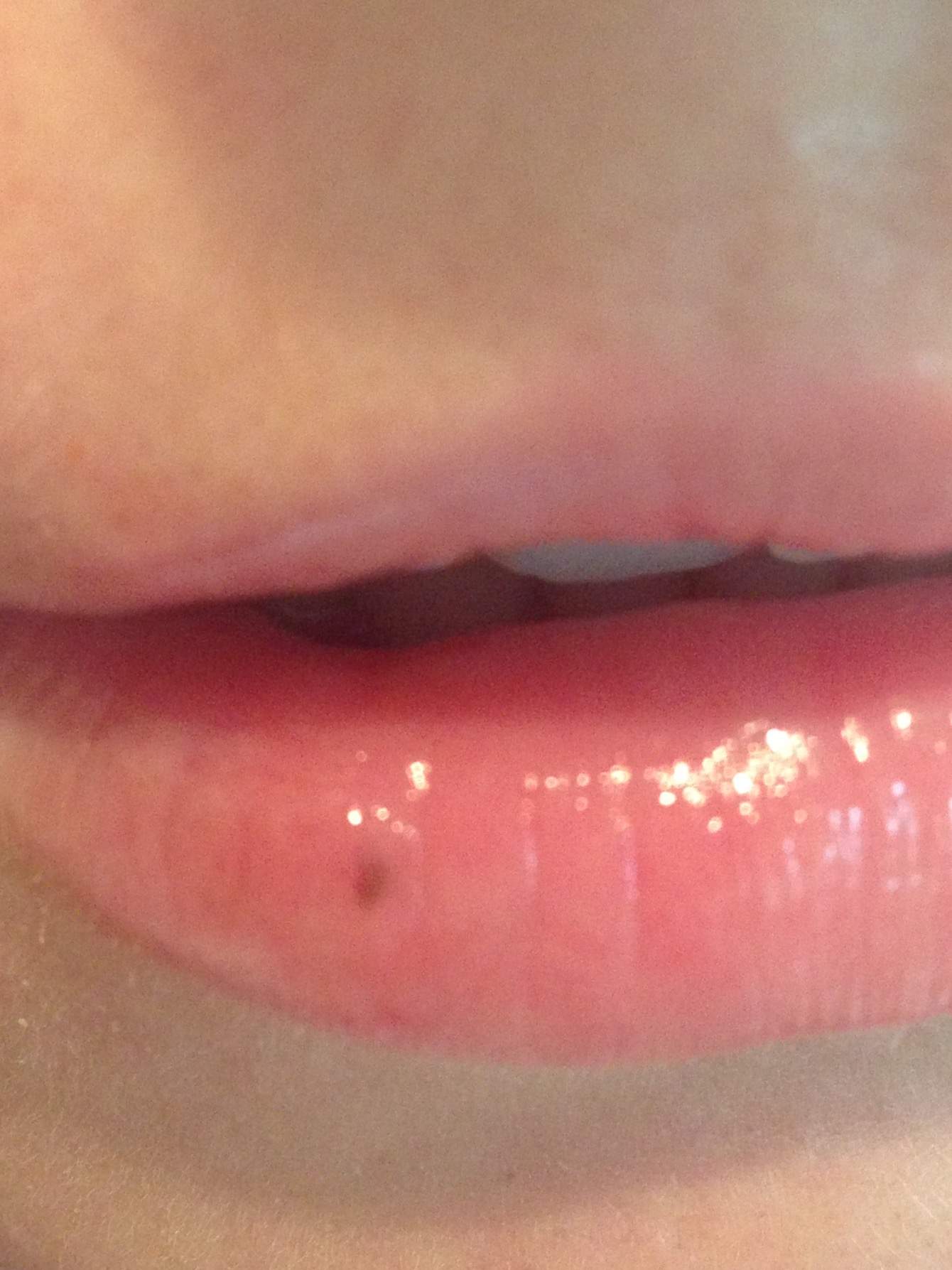 Schwarzer Fleck Unter Der Haut Der Unterlippe Flecken Lippe Schwarzer Fleck Unter Der Haut Der Unterlippe Flecken Lippe