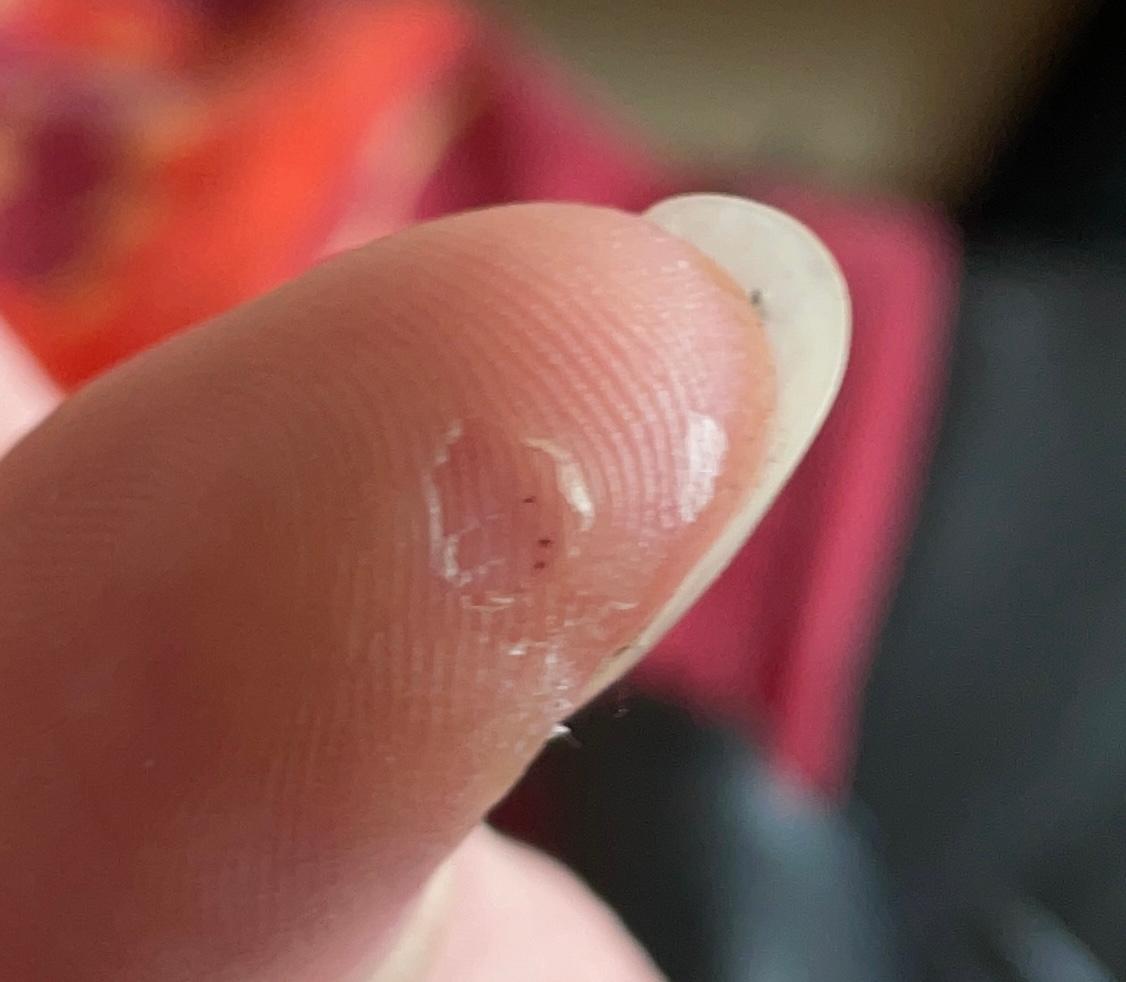 Schwarzer punkt am Daumen vermehrt sich? (Haut, Dermatologie)