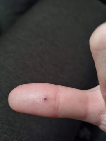 Schwarzer punkt am Finger?