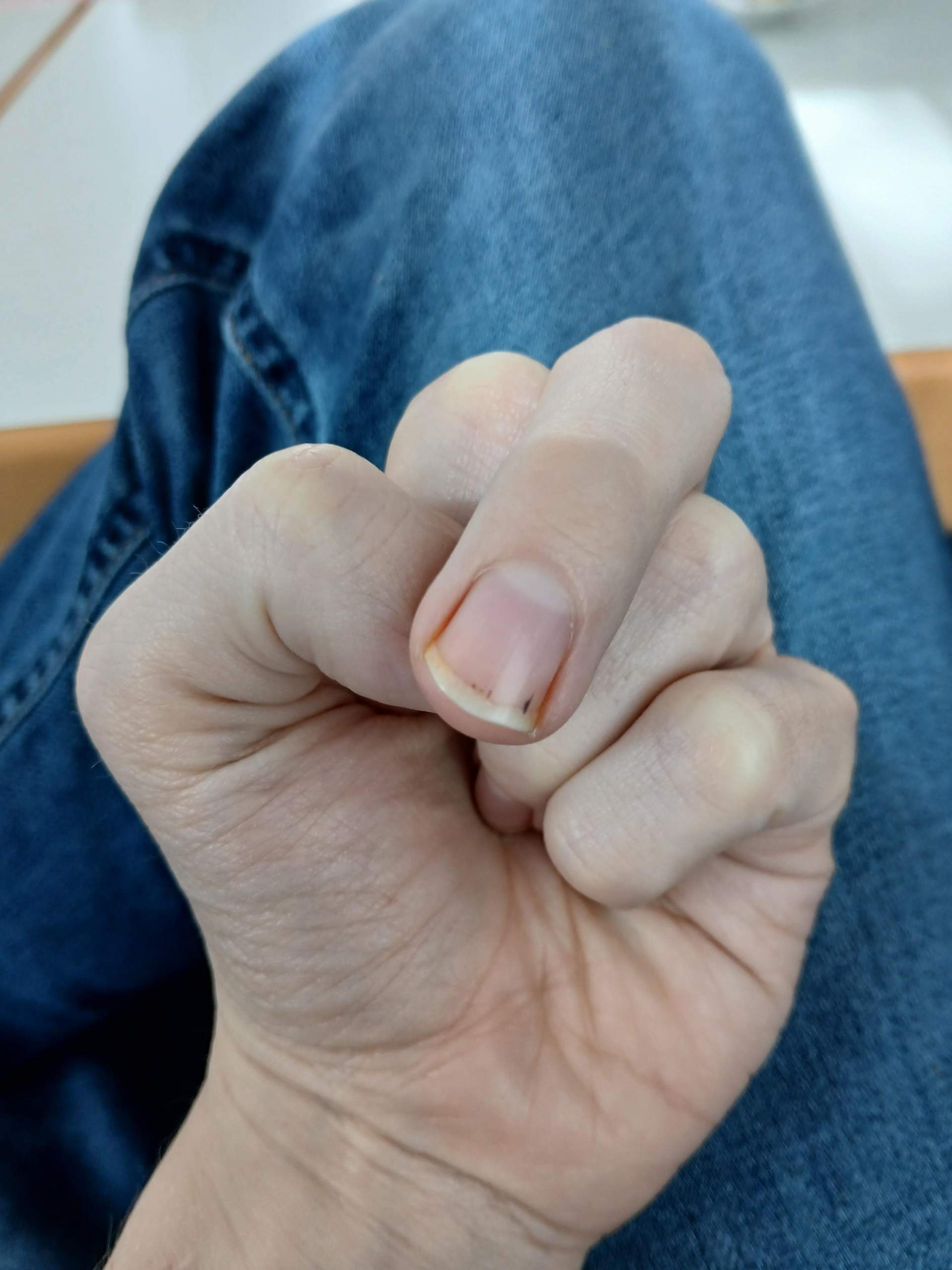 Schwarzer Strich Fingernagel? Was ist das? (Gesundheit, Verletzung, Finger)
