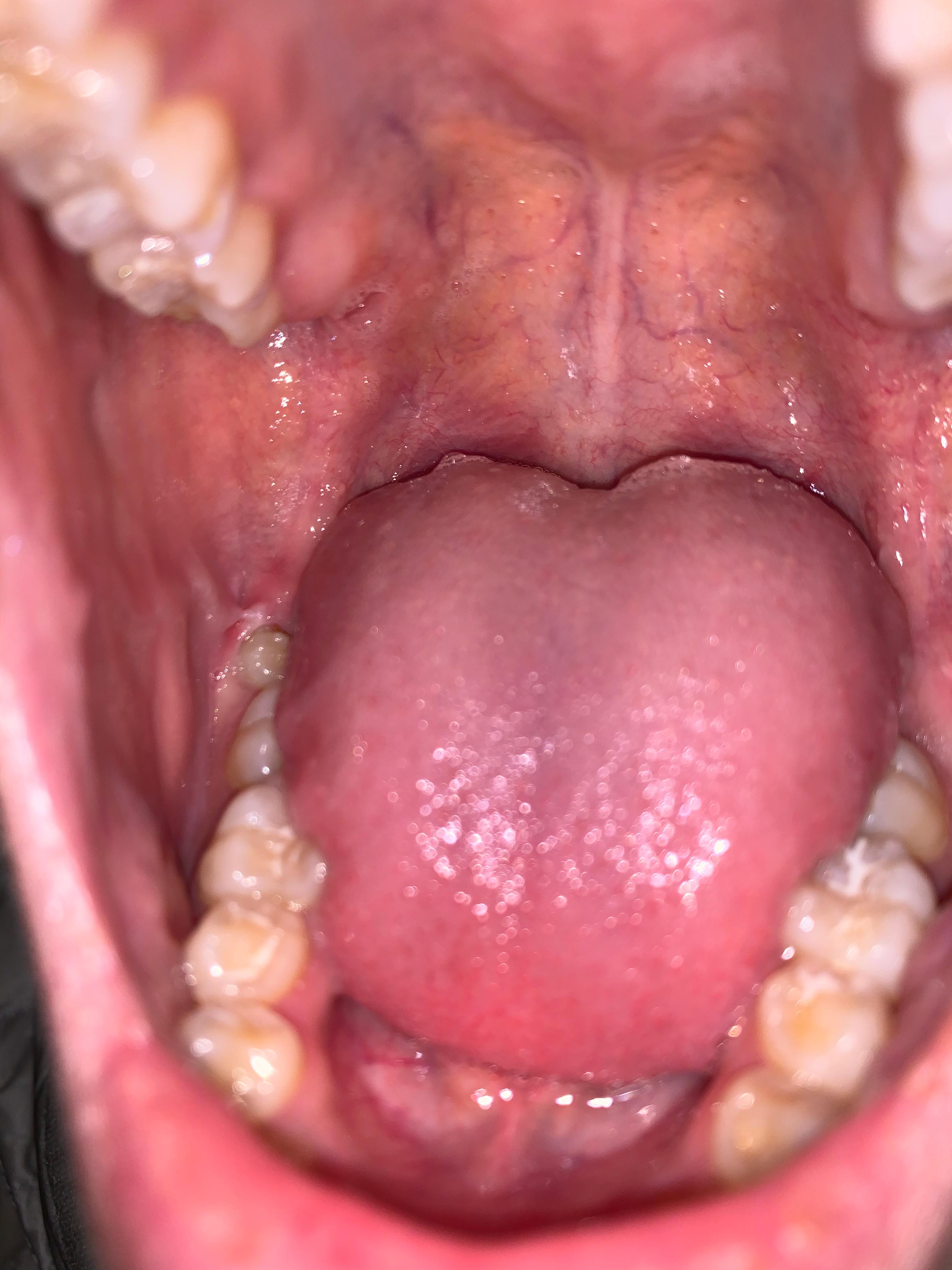 Schwellung Am Zahnfleisch Zahne Zahnarzt Zahnpflege Schwellung Am Zahnfleisch Zahne Zahnarzt Zahnpflege