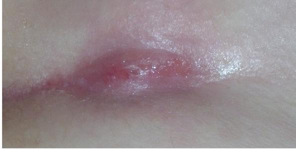 Schwellung Bzw Beule Im Steissbeinbereich Eiter Steissbein Sitzen Schwellung Bzw Beule Im Steissbeinbereich Eiter Steissbein Sitzen