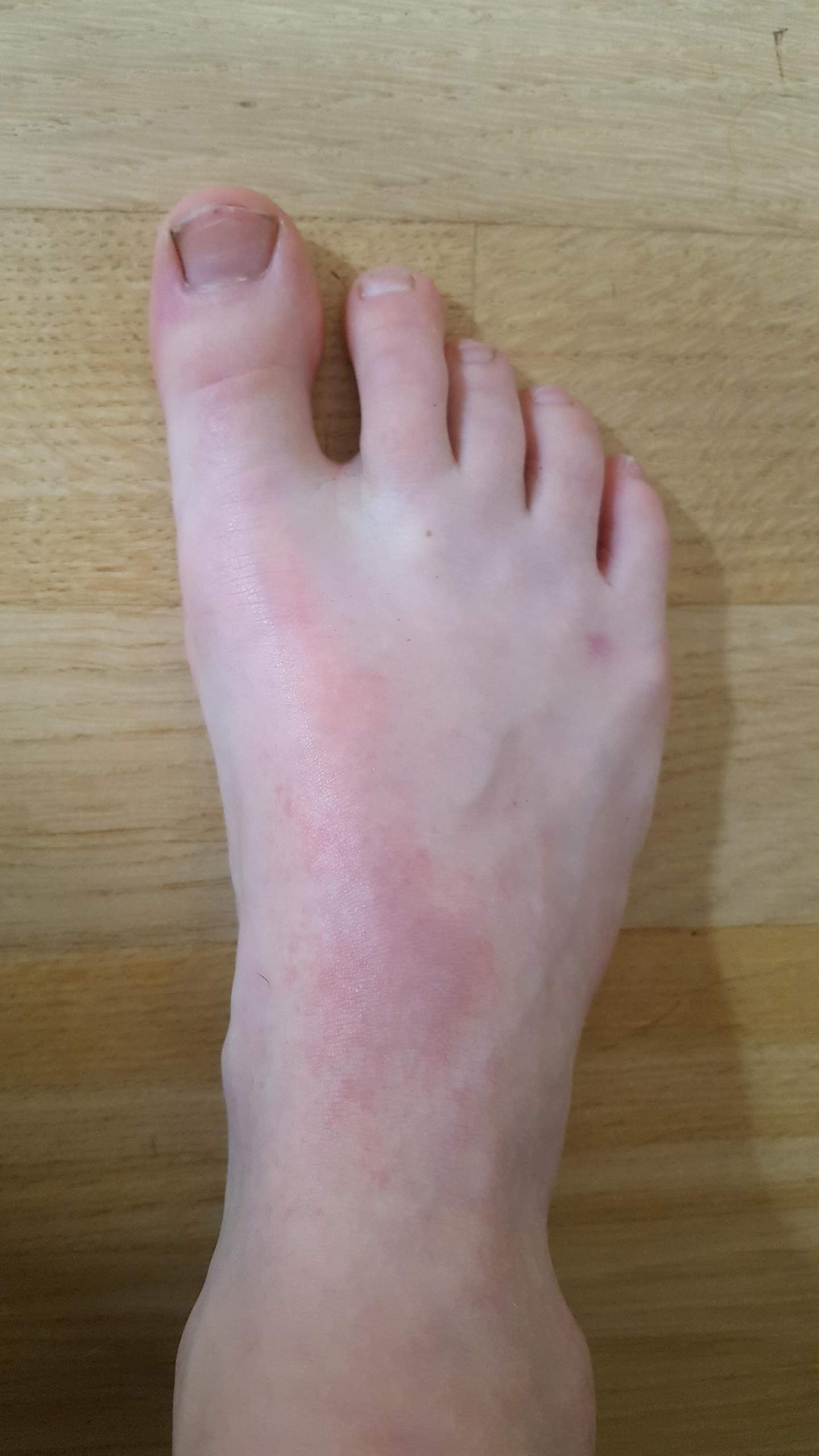 Schwellung Fußrücken nach Krafteinwirkung - Bruch? (Gesundheit, Medizin ...